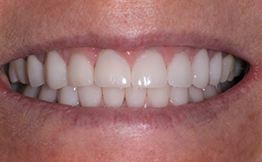 Laser Dentist in Fairfield