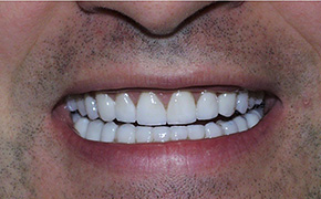 Dental Implants Dentist in Fairfield