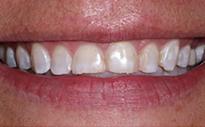 Laser Dentist in Fairfield